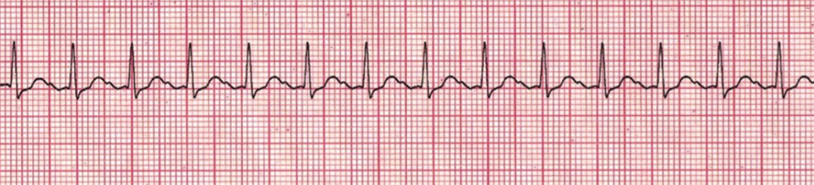 Heart rhythm case-3