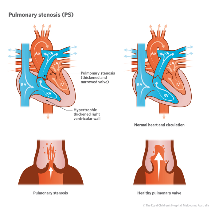 Illustration of heart with pulmonary stenosis