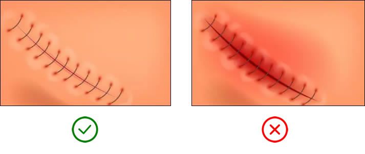 Stitched wound and infected wound