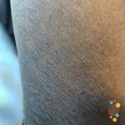 Lichenification on body of child