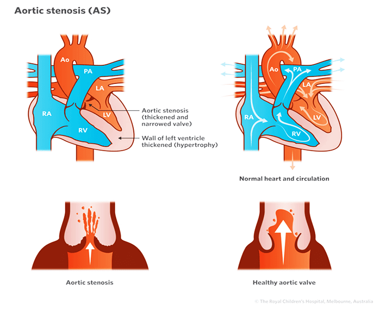 Diagram showing valves of normal heart compared to thickened and narrowed valve of heart with aortic stenosis.