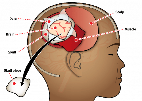 During a crantiotomy we peel back scalp and head muscle, and remove a piece of skull. We then peel back a protective layer called the dura to access the brain.